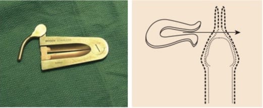 circoncision-pince-Mogen