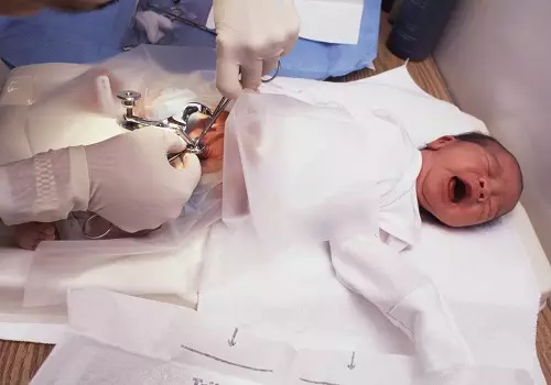 circoncision-bebe-chirurgien