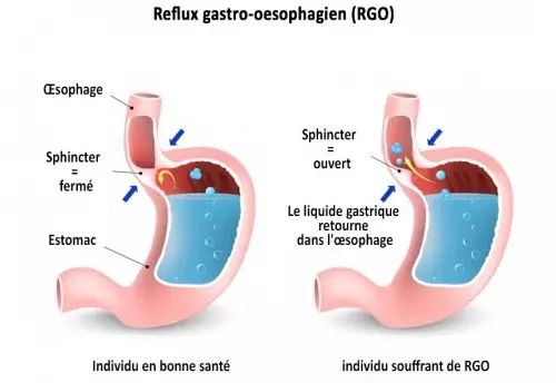 reflux-gastro-oesophagien
